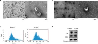 Serum and Serum Exosomal CircRNAs hsa_circ_0001492, hsa_circ_0001439, and hsa_circ_0000896 as Diagnostic Biomarkers for Lung Adenocarcinoma